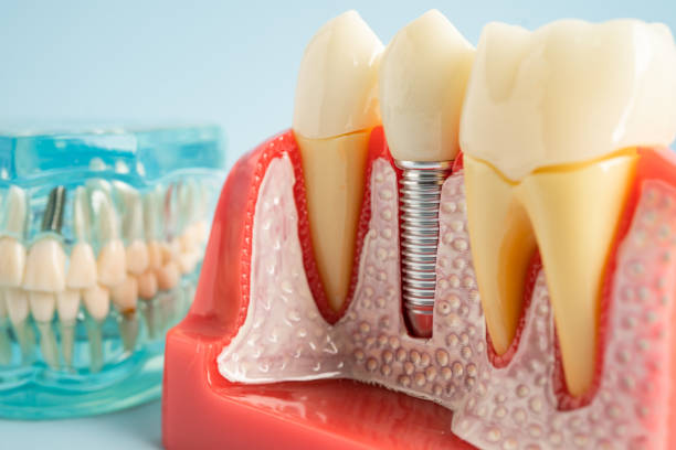 Best Root Canal Treatment  in , CT